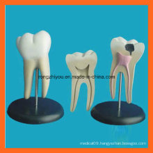 Giant Molar Anatomical Tooth Dentistry Model